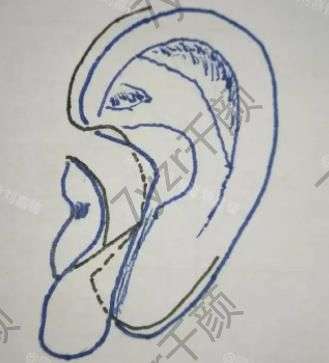 小耳畸形患者是疤痕體質(zhì)，可以做耳再造手術(shù)嗎？