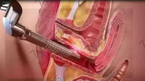 陰道松弛的癥狀和危害有哪些？