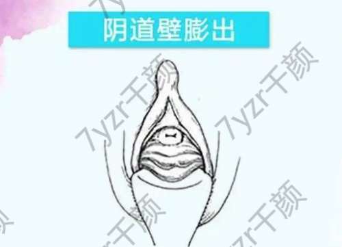 如何調(diào)節(jié)陰道前壁膨出？