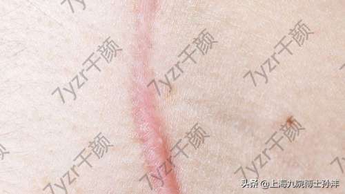 激光祛疤能去除什么樣的疤痕，幾次能做到?jīng)]有痕跡呢？