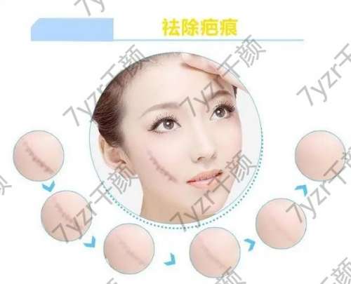 什么是激光除疤，激光除疤適合哪些人？