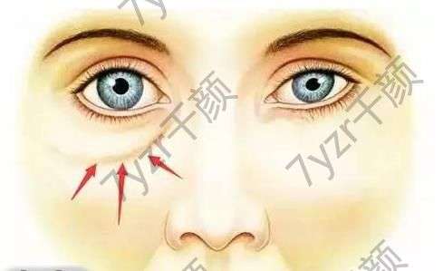 漲知識|淚溝填充——不是打一針那么簡單!