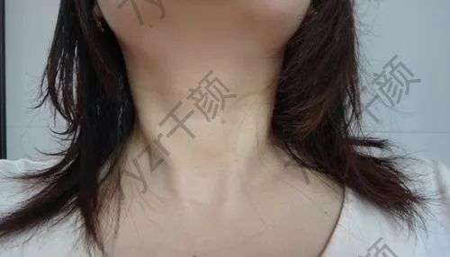 激光去除頸紋果怎么樣呢?需要做多少次