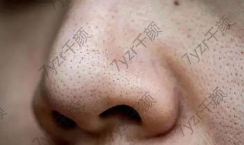 為什么一到夏天毛孔就粗大？