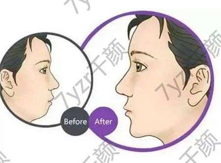 墊下巴會腫多長時間，多長時間才能消腫