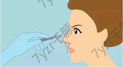 硅膠隆鼻材料什么時候可以取出?