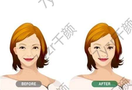 電波拉皮有哪些作用，效果能持續(xù)多久