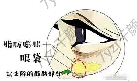 溶脂去眼袋怎么樣，要多長時(shí)間才能恢復(fù)