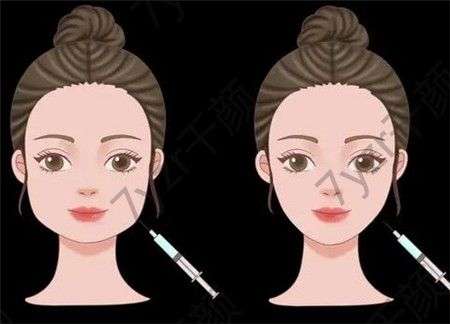 玻尿酸注射后什么時候可以敷面膜