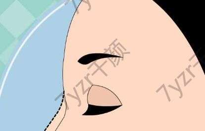 鼻翼縮小手術(shù)失敗如何修復(fù)