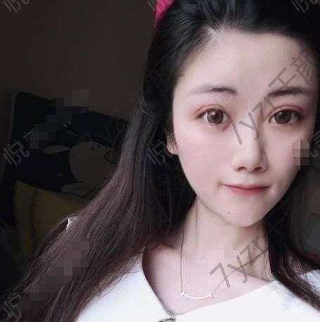 不知不覺(jué)做去眼袋的手術(shù)已經(jīng)過(guò)去半個(gè)月了