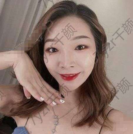 我去做眼袋的這個(gè)手術(shù)也是一次偶然的機(jī)會(huì)