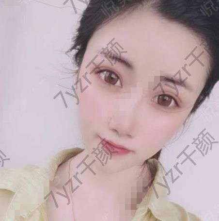 沒(méi)有眼袋了之后確實(shí)讓整個(gè)人特別的減齡