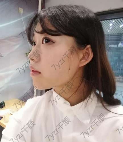 面部吸脂術(shù)后兩天臉部不再僵硬疼痛