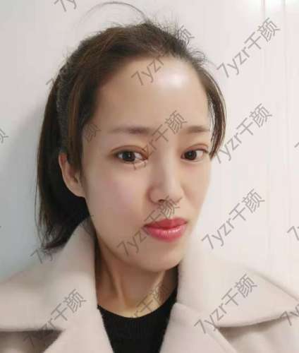 一直想做雙眼皮手術(shù)，因?yàn)檠劬φ娴暮苡绊懳业拿嬷?></a>
								</div>
								<div   id=