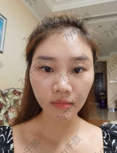 埋線雙眼皮手術(shù)后兩個(gè)月今天我化了一個(gè)漂亮的妝