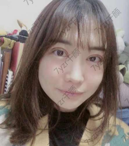 做完雙眼皮現(xiàn)在我的眼睛整條線都很好看