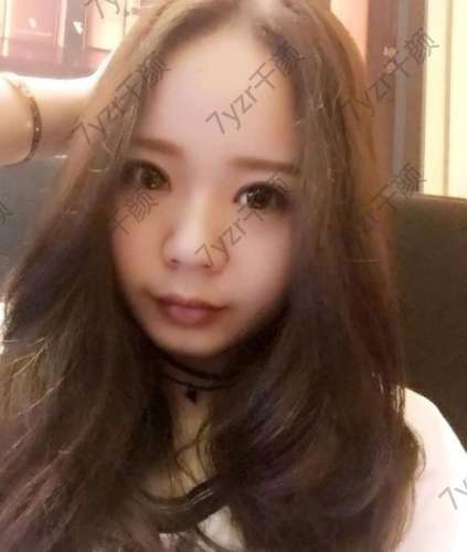 今天是我雙眼皮手術(shù)后的第七天