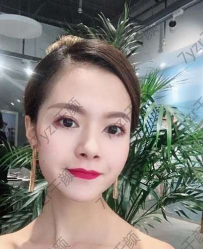 切開雙眼皮手術(shù)后兩個月雙眼皮恢復的很好