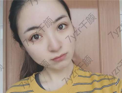 做完全切雙眼皮手術(shù)一個(gè)月了