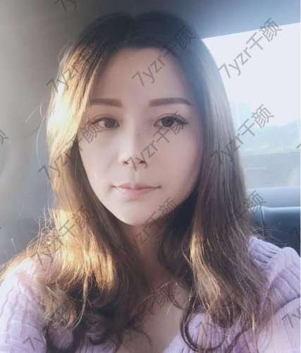 希望線雕能把我整個面部提升抬起來