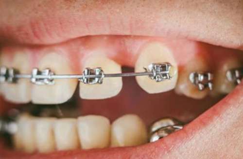 吃東西塞牙縫怎么調(diào)節(jié)？快速有效的幾種方法介紹
