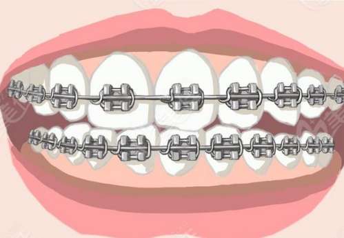 齙牙矯正，美容冠助你恢復(fù)笑容！照片證明效果驚人！