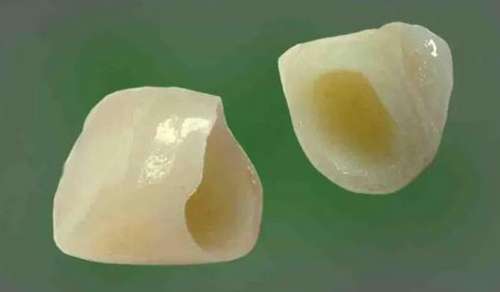 不僅烤瓷牙，還有哪些方法能夠遮暇牙齒？