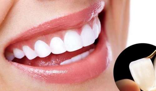 瓷貼面的好處和壞處全解析，了解一下吧！