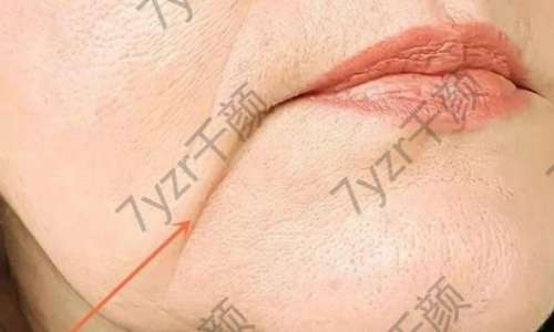 一笑嘴角兩側(cè)有括號紋？如何減緩括號紋的形成？