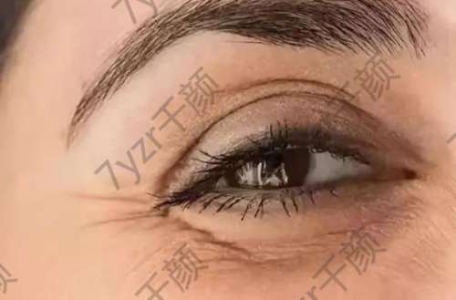 一笑眼角紋特別重是什么原因？如何預(yù)防和改良一笑眼角紋