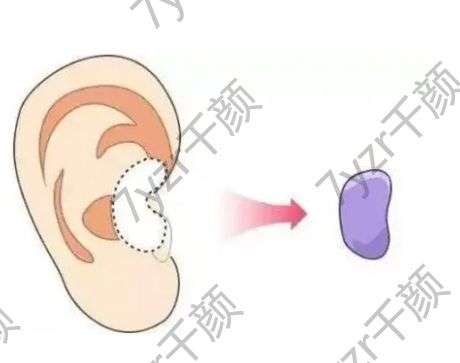 耳軟骨墊鼻尖有什么優(yōu)點(diǎn)，注意事項(xiàng)有哪些