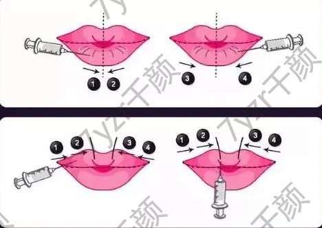 豐唇的價格一般是多少，軟化需要多長時間