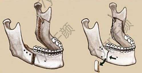 正頜手術(shù)大概多少錢？手術(shù)費(fèi)用及恢復(fù)時間詳解