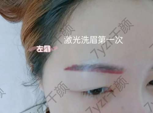 激光洗眉一般需要多少錢？了解1-7天的變化過程，注意事項