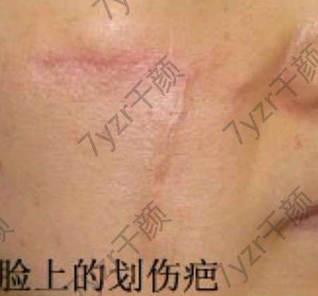 激光祛疤2cm一般多少錢？激光祛疤恢復過程圖一覽