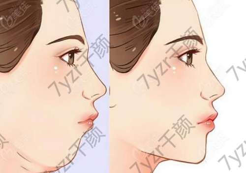 雙下巴抽脂手術(shù)大概花多少錢？價(jià)格區(qū)間介紹，醫(yī)院、風(fēng)險(xiǎn)詳細(xì)了解