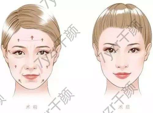 脂肪填充多了怎么辦？脂肪填充恢復時間大講解