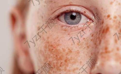 肝斑和黃褐斑的區(qū)別及方法