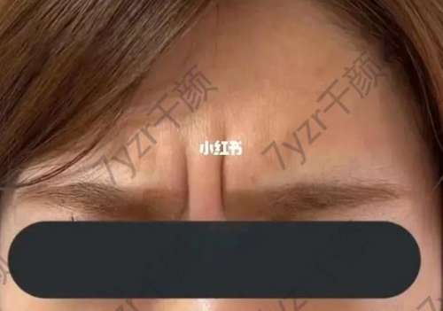 額頭打除皺針的危害及后期副作用，以及恢復(fù)時(shí)間